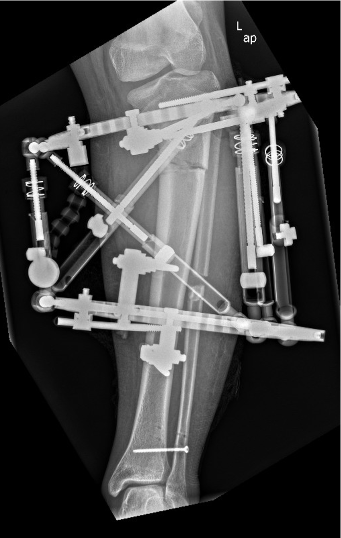 Lower-leg deformity correction radiograph with external fixator