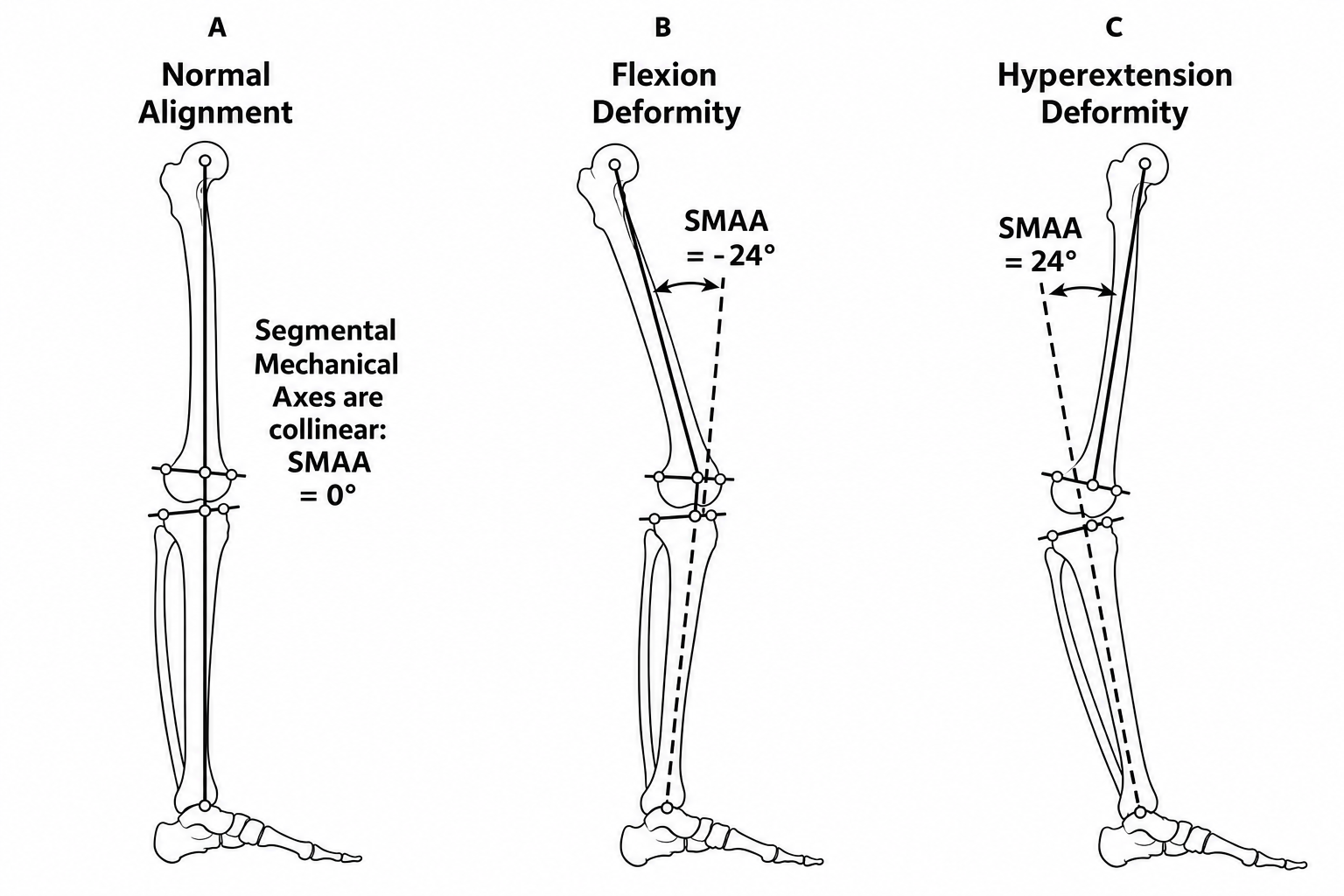 Monochrome sagittal mechanical axes angle drawing showing minus 24 and plus 24 degrees